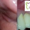 implant_lucz